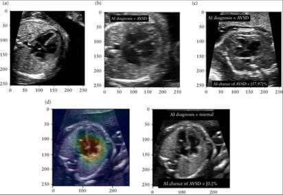 Совместная роль ИИ и врачей США в выявлении врожденных пороков сердца